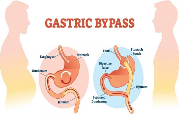 6 Major Health Benefits Of Gastric Bypass Surgery Dr Sachin Kukreja Dallas Fort Worth Tx 